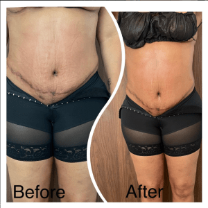 Lymphatic Drainage Therapy