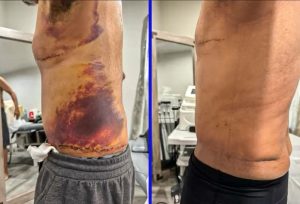 Lymphatic Drainage Therapy